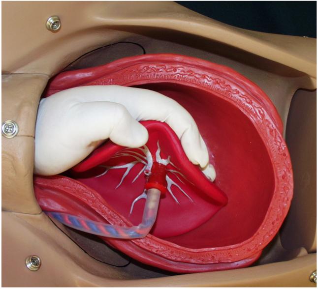 Retained Placenta